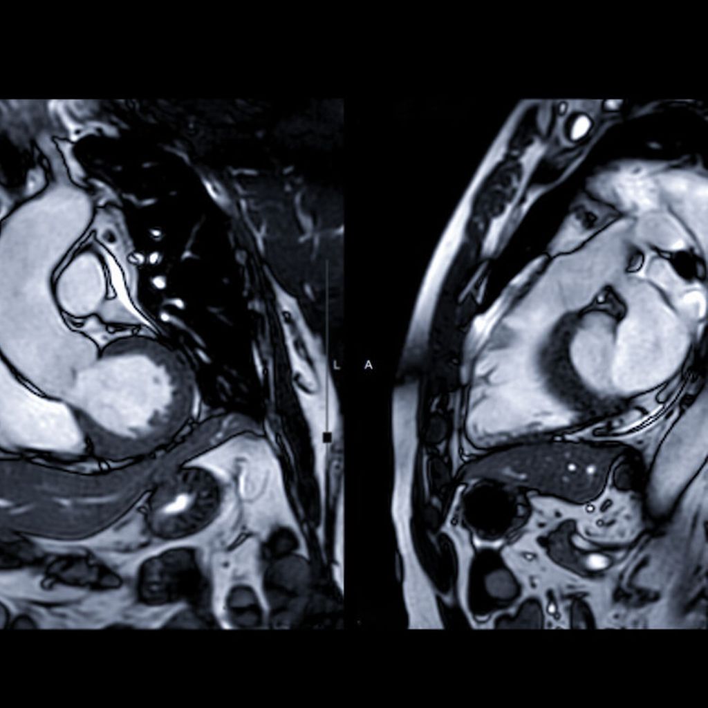 Diagnostik Seltener Hypertropher Kardiomyopathien Fokus Kardiales Mrt Kardiologie